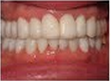 Whiter Smile after 292202