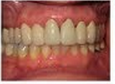 Whiter Smile before 292202