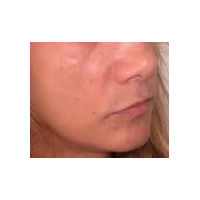 45-54 year old woman treated with Lip Augmentation before 2986811