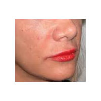 45-54 year old woman treated with Lip Augmentation after 2986811