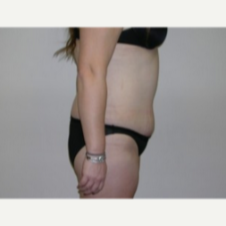 25-34 year old woman treated with Liposuction 1893077