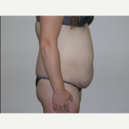 25-34 year old woman treated with Liposuction 1893077