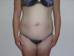 25-34 year old woman treated with Liposuction before 1893077