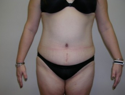 25-34 year old woman treated with Liposuction after 1893077