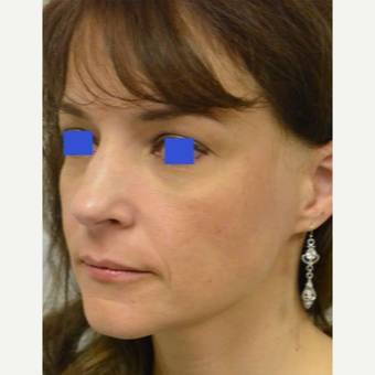 45-54 year old woman treated with a wide nose treated with a Rhinoplasty before 3482842