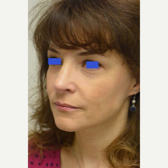 45-54 year old woman treated with a wide nose treated with a Rhinoplasty after 3482842