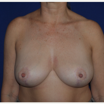 52 year old woman treated with a Breast Reduction after 3776351