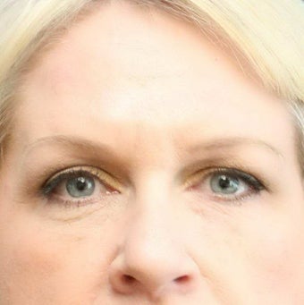 Lower Eyelid Bags Non Surgical Treatment with Artefill (Bellafill) | Frown and Forehead Treated with BOTOX after 1461259