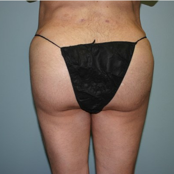 Brazilian Butt Lift after 3667637