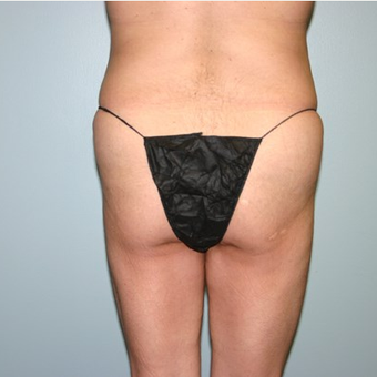 Brazilian Butt Lift before 3667637