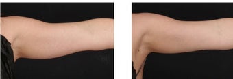 CoolSculpting non-invasively eliminates excess fat on the arms. before 1088397