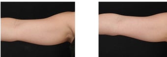 CoolSculpting non-invasively eliminates excess fat on the arms. after 1088397