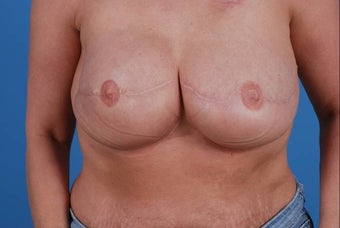47 year old female treated for breast cancer post mastectomy after 1355462
