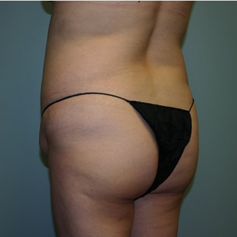 Brazilian Butt Lift before 3667520