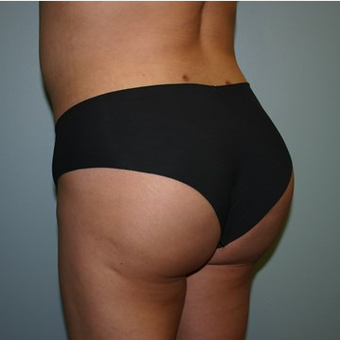 Brazilian Butt Lift after 3667520