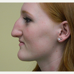 18-24 year old woman treated with Rhinoplasty before 3370717
