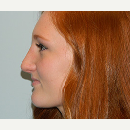 18-24 year old woman treated with Rhinoplasty after 3370717