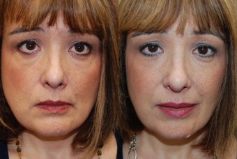 Silikon-1000 for undereyes, nasolabial folds, lips and corners of mouth. before 938896