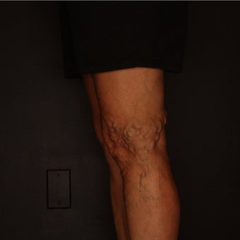 55-64 year old man treated with Sclerotherapy before 2081435