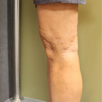 55-64 year old man treated with Sclerotherapy after 2081435