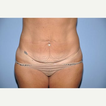 45-54 year old woman treated with Mommy Makeover before 1564887