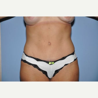 45-54 year old woman treated with Mommy Makeover after 1564887