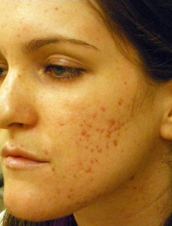 Acne Scars Laser Surgery before 667022