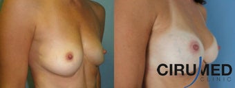Composite Supercharged Breast Augmentation (silicone/fat) after 1285088
