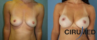 Composite Supercharged Breast Augmentation (silicone/fat) before 1285088