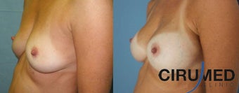 Composite Supercharged Breast Augmentation (silicone/fat) 1285088