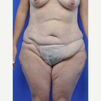 35-44 year old woman treated with Body Lift before 3450483