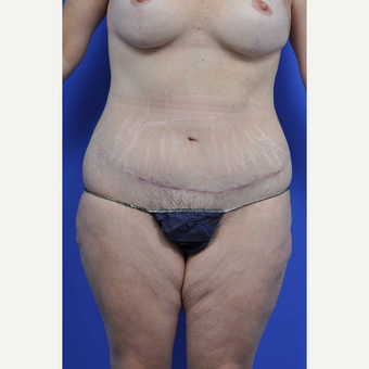 35-44 year old woman treated with Body Lift after 3450483