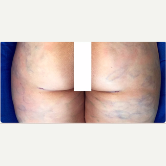 35-44 year old woman treated with Fat Transfer after 3578286