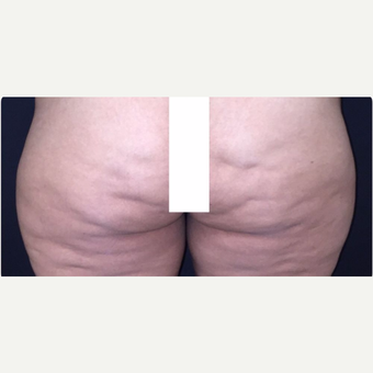 35-44 year old woman treated with Fat Transfer before 3578286