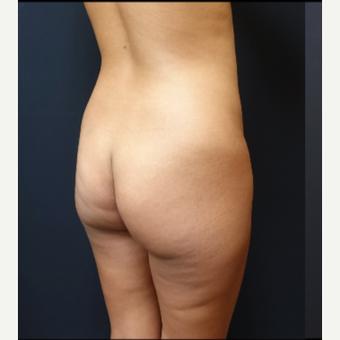 25-34 year old woman treated with Brazilian Butt Lift before 3731873