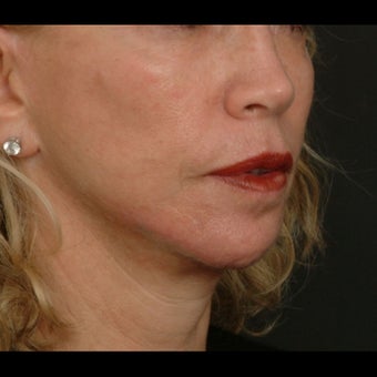 65-74 year old woman treated for Liquid Facelift after 1479646