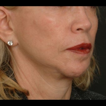 65-74 year old woman treated for Liquid Facelift before 1479646