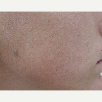 Acne treatment after 3679299
