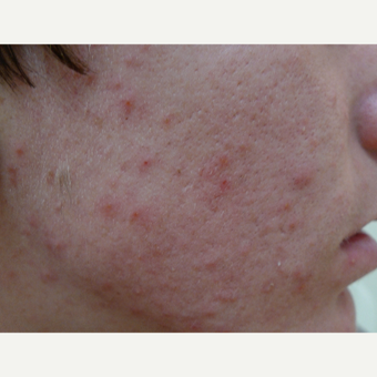 Acne treatment before 3679299