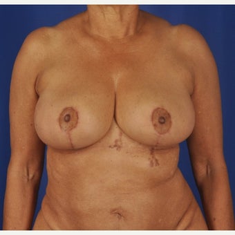 75 year-old woman underwent breast reduction after 2392227