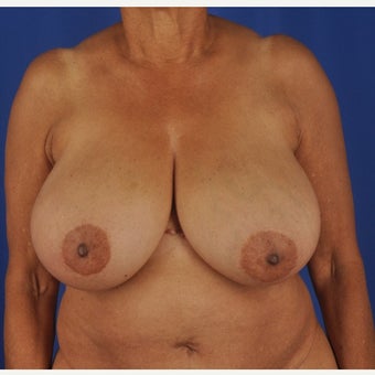 75 year-old woman underwent breast reduction before 2392227