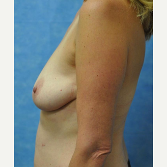 45-54 year old woman treated with Breast Lift with Implants before 3440939
