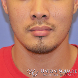35-44 year old man treated with Alarplasty (nostril narrowing) after 3489539