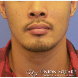 35-44 year old man treated with Alarplasty (nostril narrowing) before 3489539