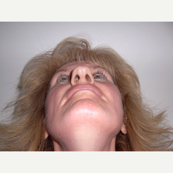 45-54 year old woman treated with Rhinoplasty before 3122828