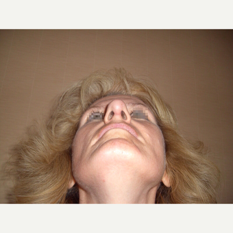45-54 year old woman treated with Rhinoplasty after 3122828
