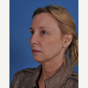 55-64 year old woman treated with Facelift before 3437566
