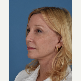 55-64 year old woman treated with Facelift after 3437566