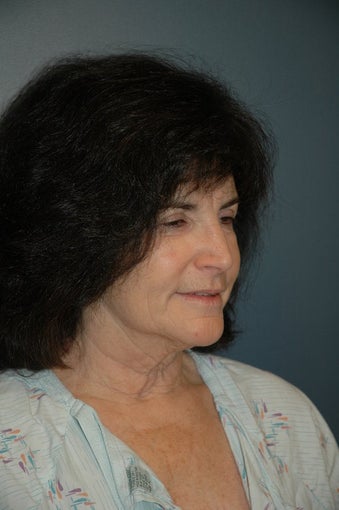 Cheek and Neck Lift before 74987