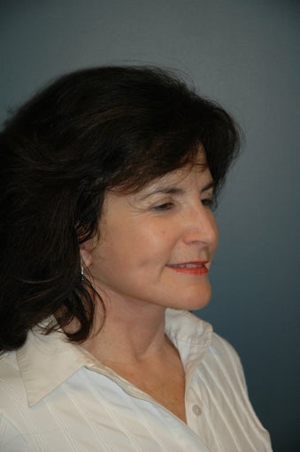 Cheek and Neck Lift after 74987